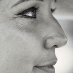 Fine lines and wrinkle Treatemnt